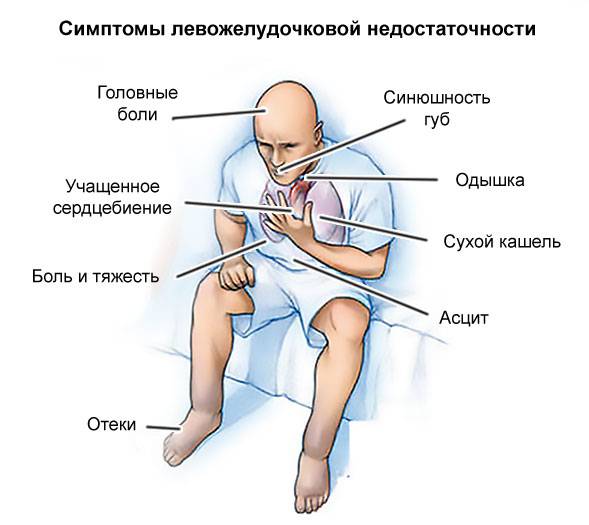 симптомы левожелудочковой недостаточности