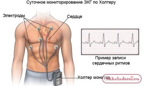 Что такое холтеровское мониторирование ЭКГ Что такое холтеровское мониторирование ЭКГ