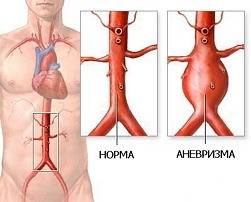 аневризма аорты фото