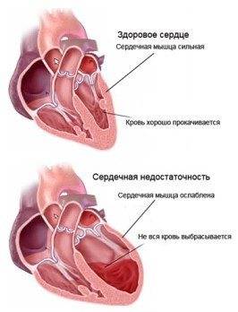 причины сердечного кашля