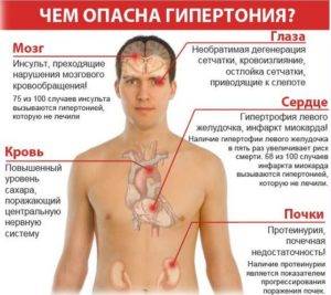 Опасность гипертонии