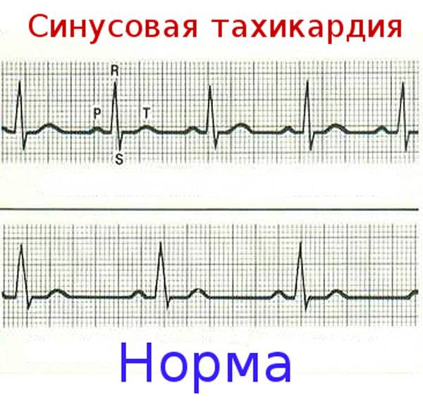 Синусовая тахикардия на ЭКГ