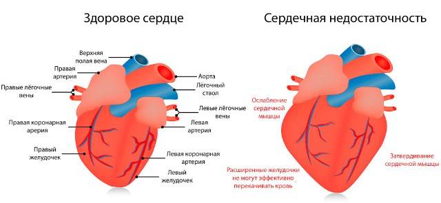 Сердечная недостаточность