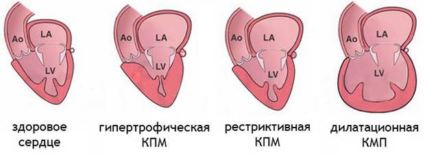 кардиомиопатии виды