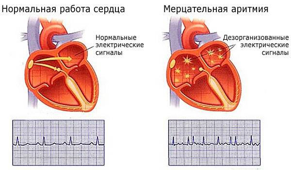 Нормальная работа сердца и мерцательная аритмия Нормальная работа сердца и мерцательная аритмия
