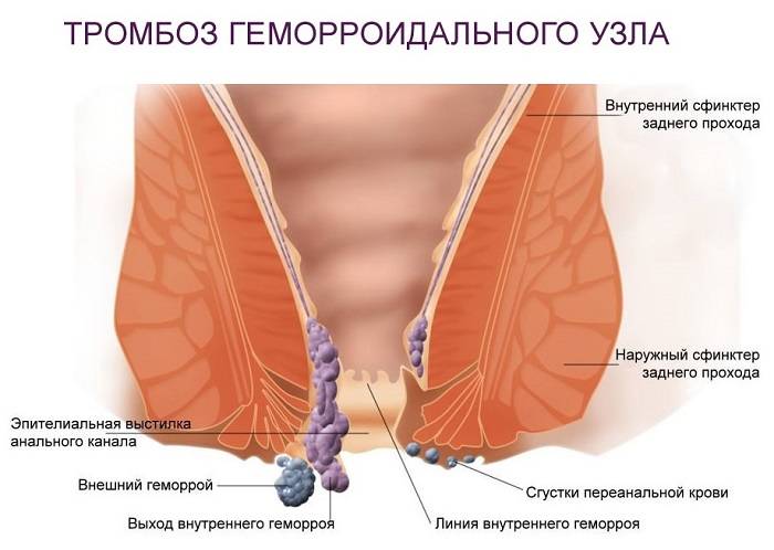 Тромбоз