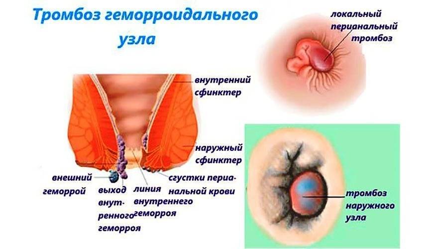 Тромбоз геморроидального узла