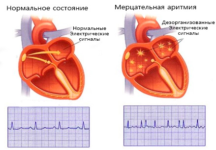 мерцательная аритмия мерцательная аритмия