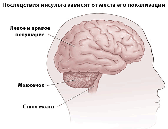 Последствия инсульта у мужчин