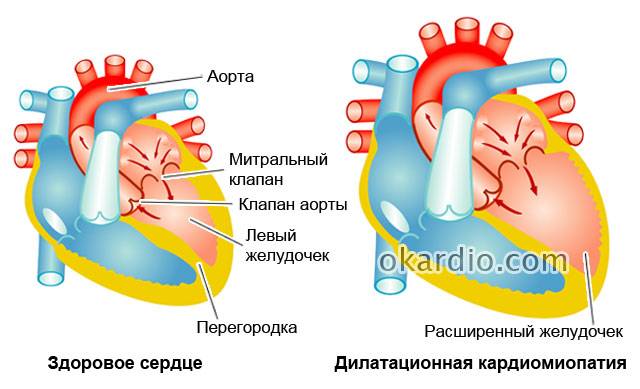 сравнение здорового сердца и дилатационной кардиомиопатии
