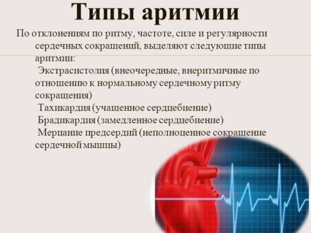 Типы аритмии