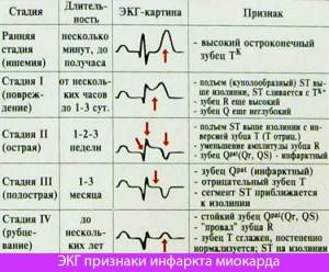 infarkta-miokarda-na-ekg