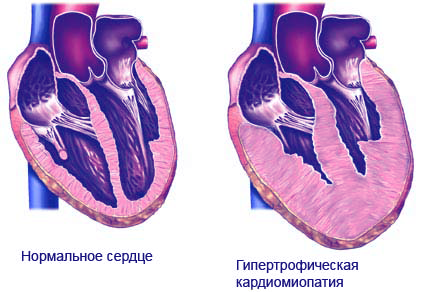Лечение кардиомиопатии