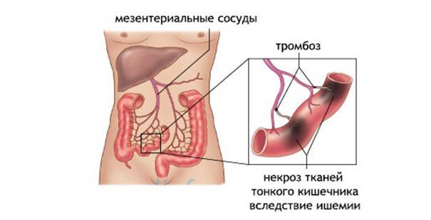 Что такое тромбоз кишечника, каковы причины, симптомы и лечение мезентериального инфаркта?