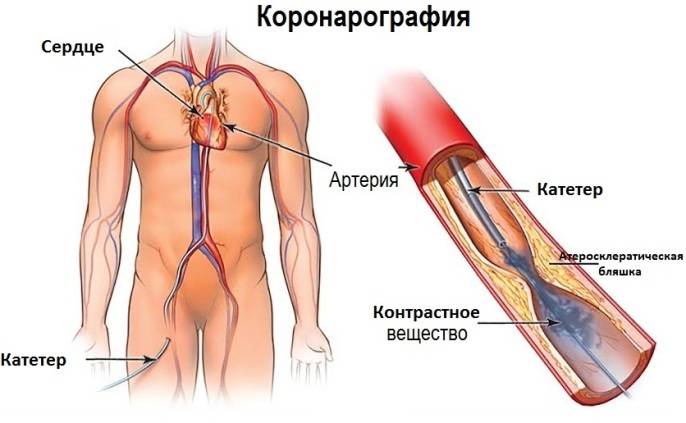 Коронарография сердца