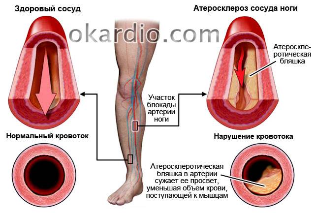 атеросклероз сосуда ноги