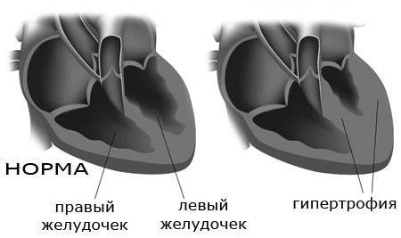 Гипертрофия левого желудочка сердца