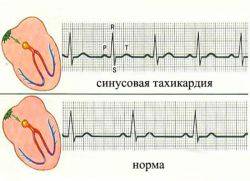 Чем опасна синусовая тахикардия сердца