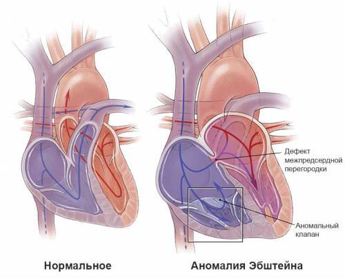 Аномалия Эбштейна