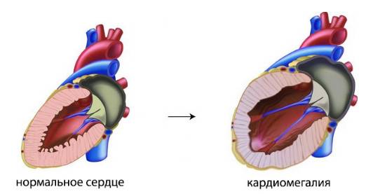 что такое кардиомегалия