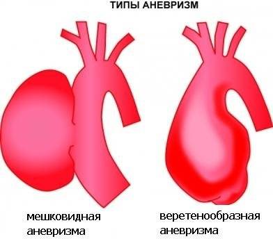 Пример аневризмы Пример аневризмы