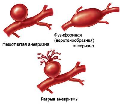 Типы аневризм Типы аневризм