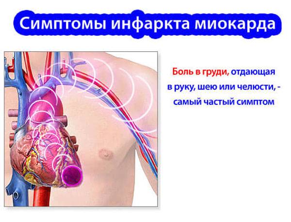 Симптомы инфаркта миокарда