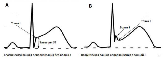 Классическое определение СРРЖ на ЭКГ (элевация сегмента ST)