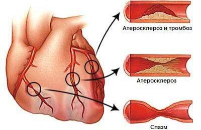 Больное сердце