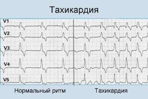 Учащенное сердцебиение