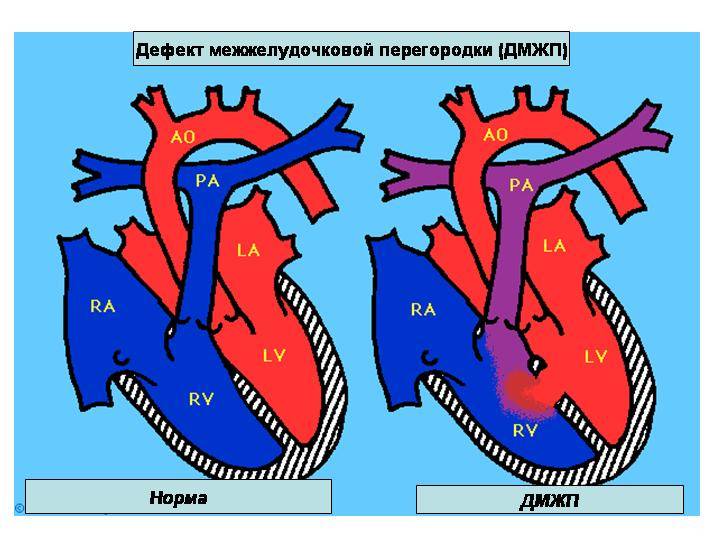 У взрослых людей дефект межжелудочковой перегородки не встречается, так как операция по устранению проводится в детском возрасте и успешно выполняется уже на протяжении пятидесяти лет.