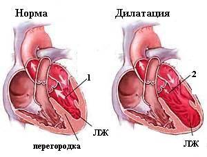 Сердечная астма