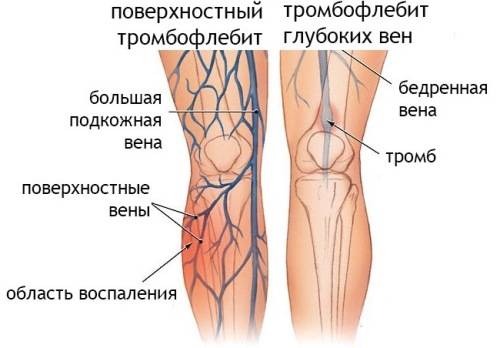Тромбофлебит вен нижних конечностей