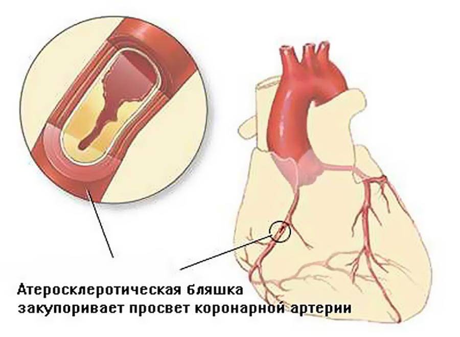 Атеросклеротическая бляшка