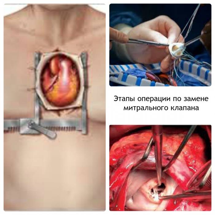Операция на открытом сердце