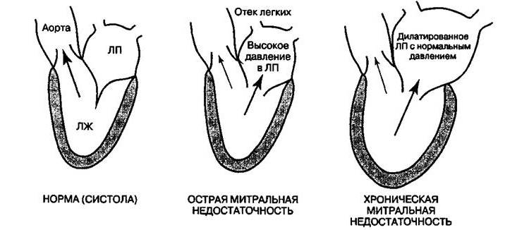 Виды заболевания и их схема