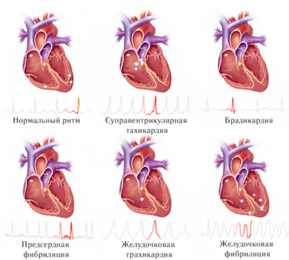 Нарушения сердечного ритма Нарушения сердечного ритма
