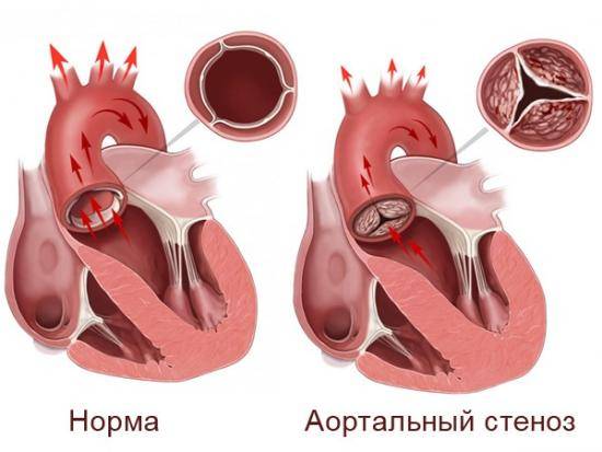 стеноз аорты симптомы
