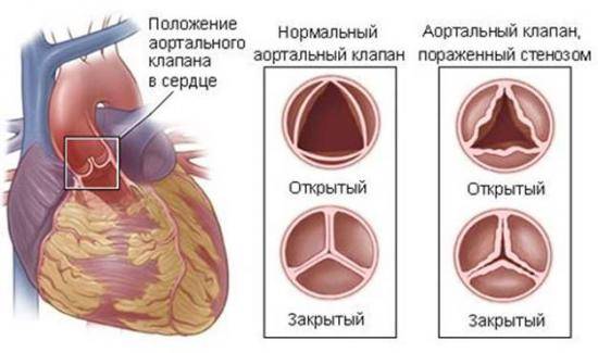 стеноз аорты симптомы