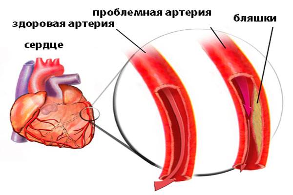 диагностика стенокардии диагностика стенокардии