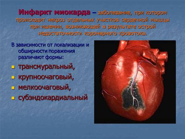 Виды инфаркта миокарда