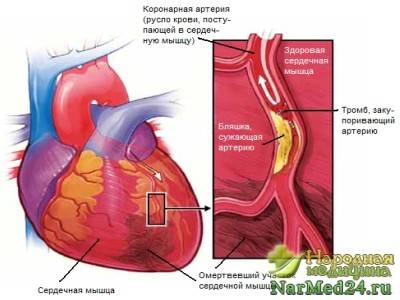 стенокардия определение стенокардия определение