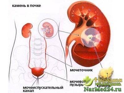 стенокардия причины стенокардия причины