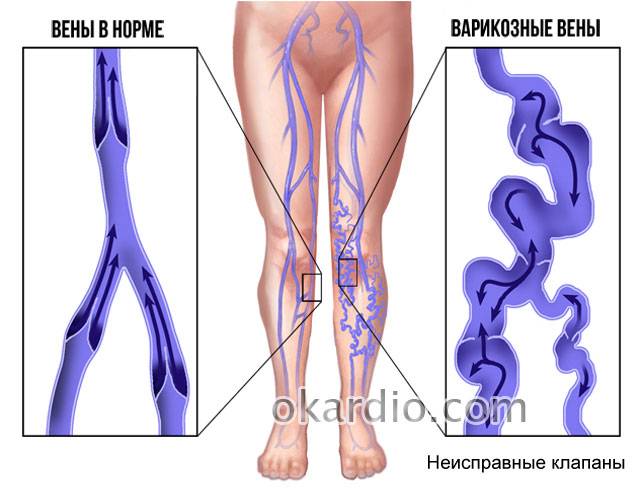 варикоз