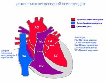 дефект межпредсердной перегородки