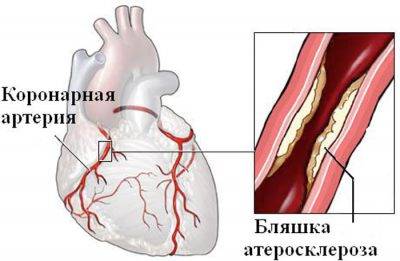 Коронарные артерии