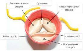 Кальциноз аортального клапана