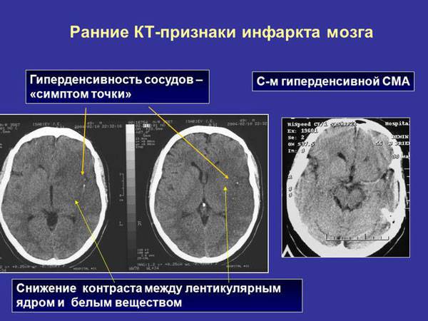 Ранние КТ-признаки инфаркта миокарда