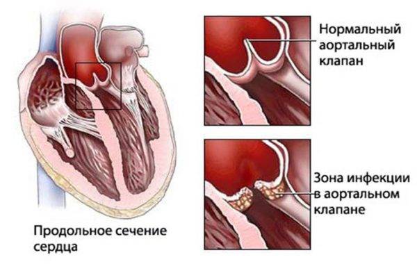 Поражение сердца Воспалительный процесс в слоях сердца