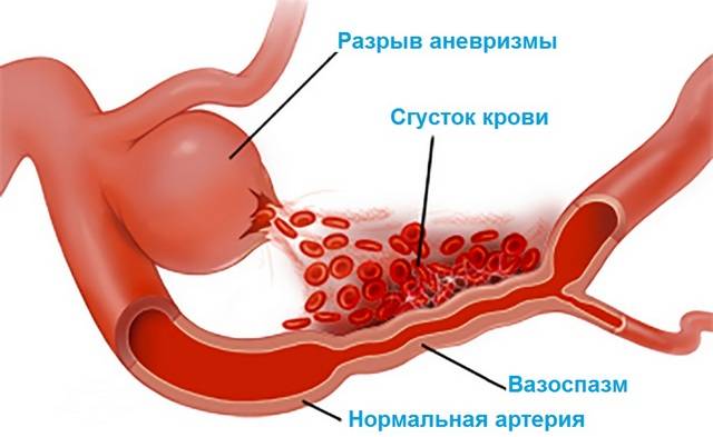 Вазоспазм сосудов головного мозга Вазоспазм сосудов